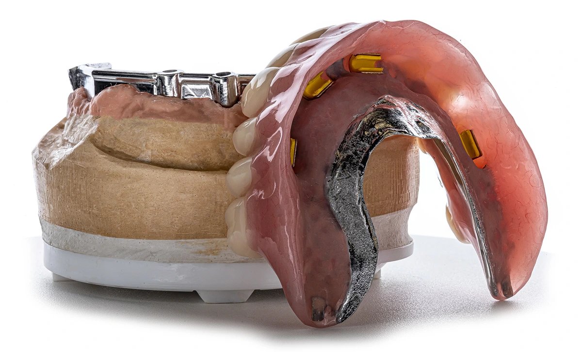 Implant Supported Dentures vs. Traditional Dentures: A Specialist’s Comparison (2026)