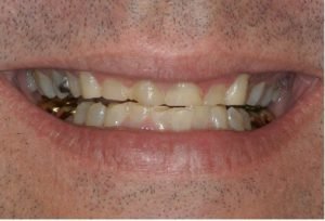 bruxism treatment 11364: Everything You Need to Know