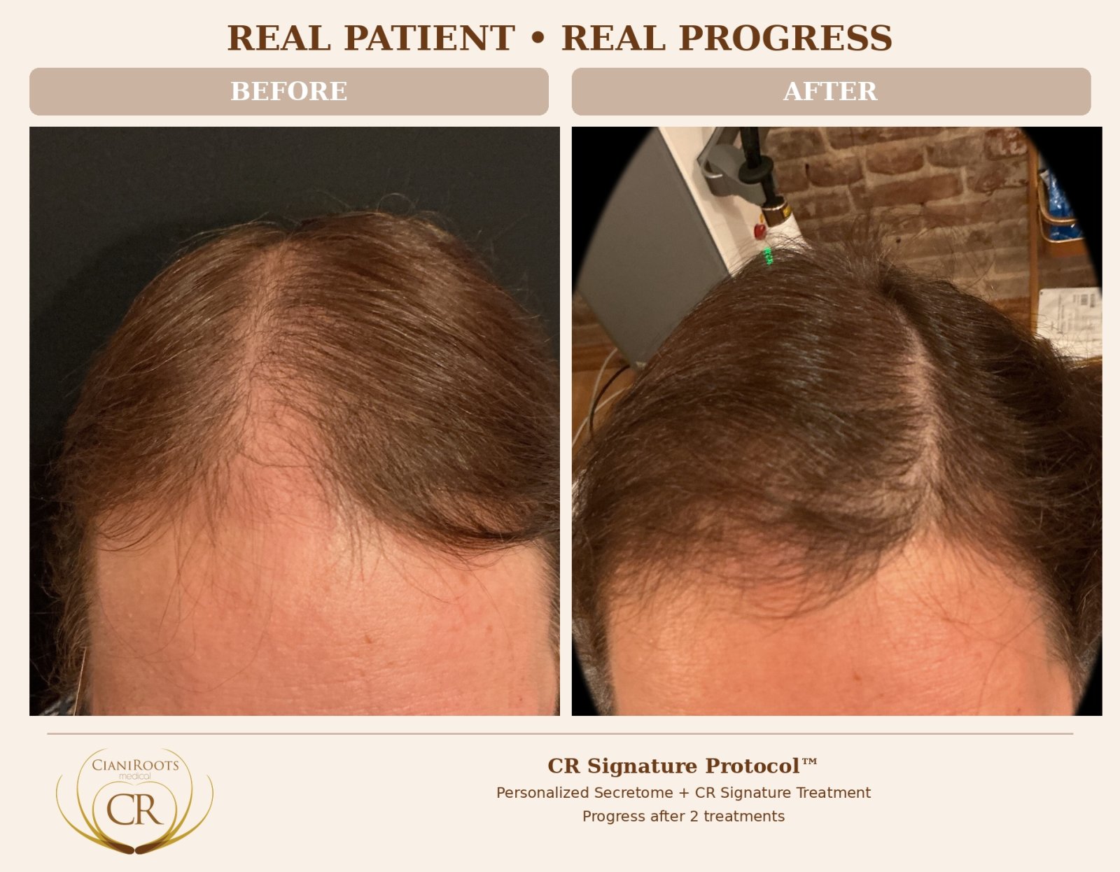Alternatives to Finasteride for Hair Loss: A Clear Comparison