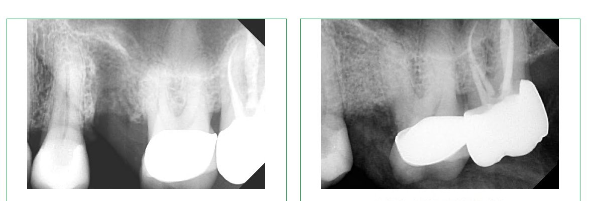 Bone Graft for Dental Implant: Why It Is Necessary