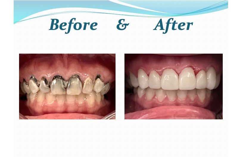 What is Full Mouth Rehabilitation? A Specialist View
