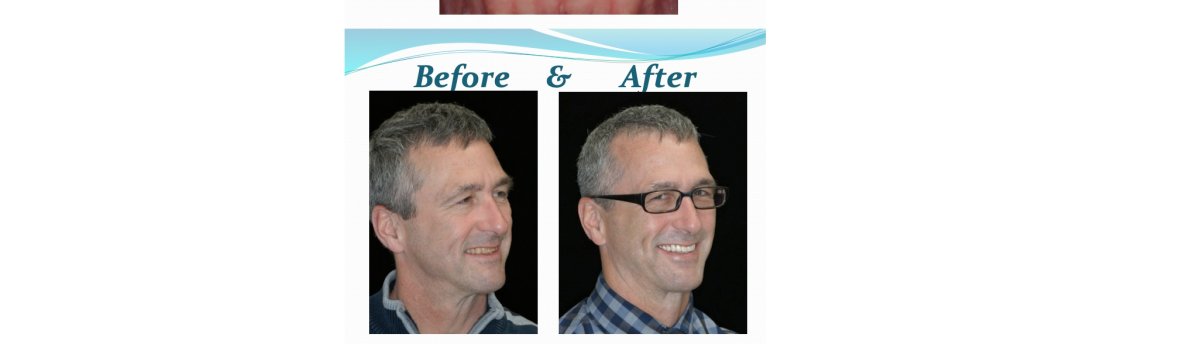 Full Mouth Reconstruction Falls Church: Reclaim Your Smile