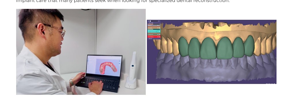 The Full Mouth Reconstruction Process in Falls Church