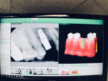 Cost of Dental Implants in Northern VA: A Value Breakdown