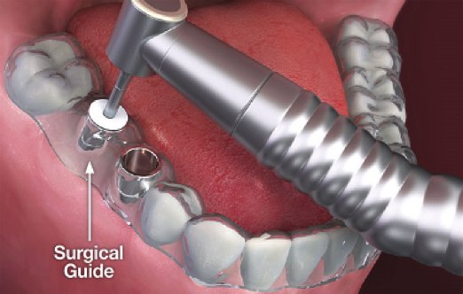 Are Dental Implants Painful? Expert Insights