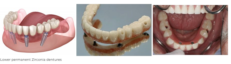 All-on-4 Dental Implants Northern VA: Fixed Solutions