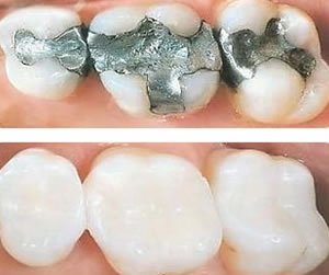 Dental Bonding Falls Church: Fast Chipped Tooth Repair