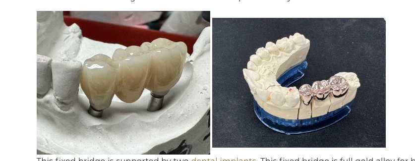 Dental Bridge vs Implant: Which Is Better for You?
