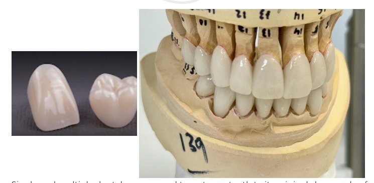 Dental Crowns Falls Church: Materials and Durability