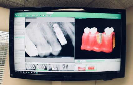 Dental Implant Success Rate and Long-Term Care