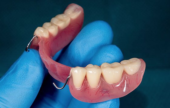 How to Make Dentures Fit Better and Avoid Sores