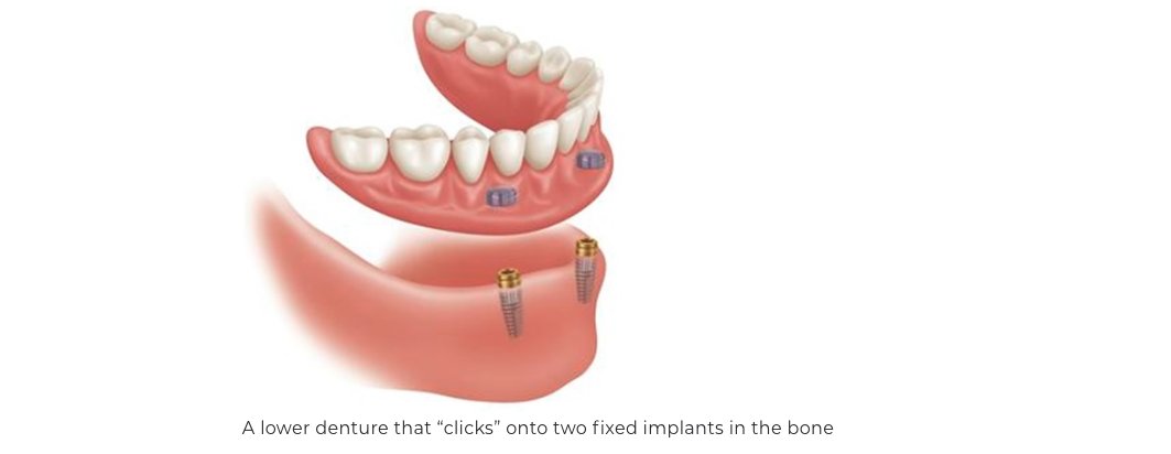 Implant Retained Dentures in Tysons Corner: A Local Guide