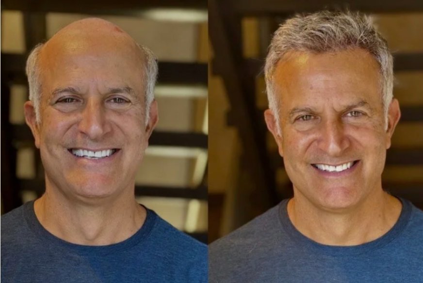 Men Hair Replacement Los Angeles