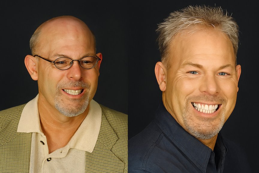 Hair Replacement Los Angeles