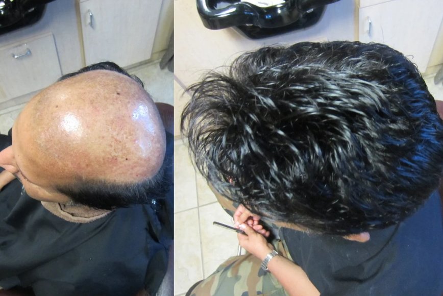 Hair Loss Cure
