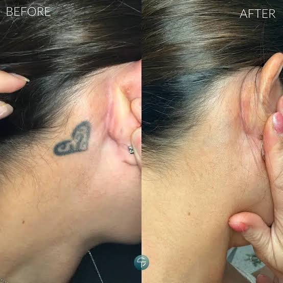 Laser tattoo removal
