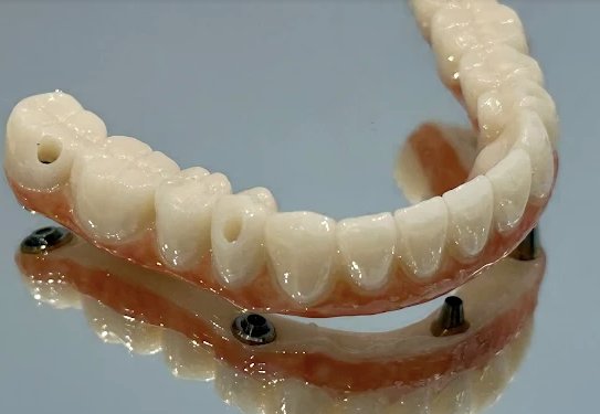 How to Master all on 6 dental implants cost Virginia for Better Results
