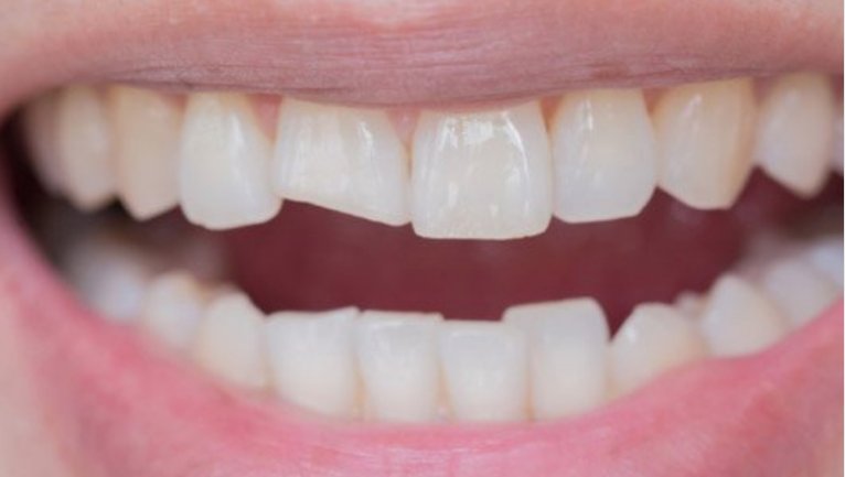 The Ultimate Guide to chipped tooth repair Great Falls VA