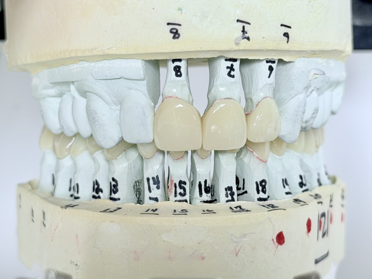 Complete full mouth reconstruction falls church Guide for Success