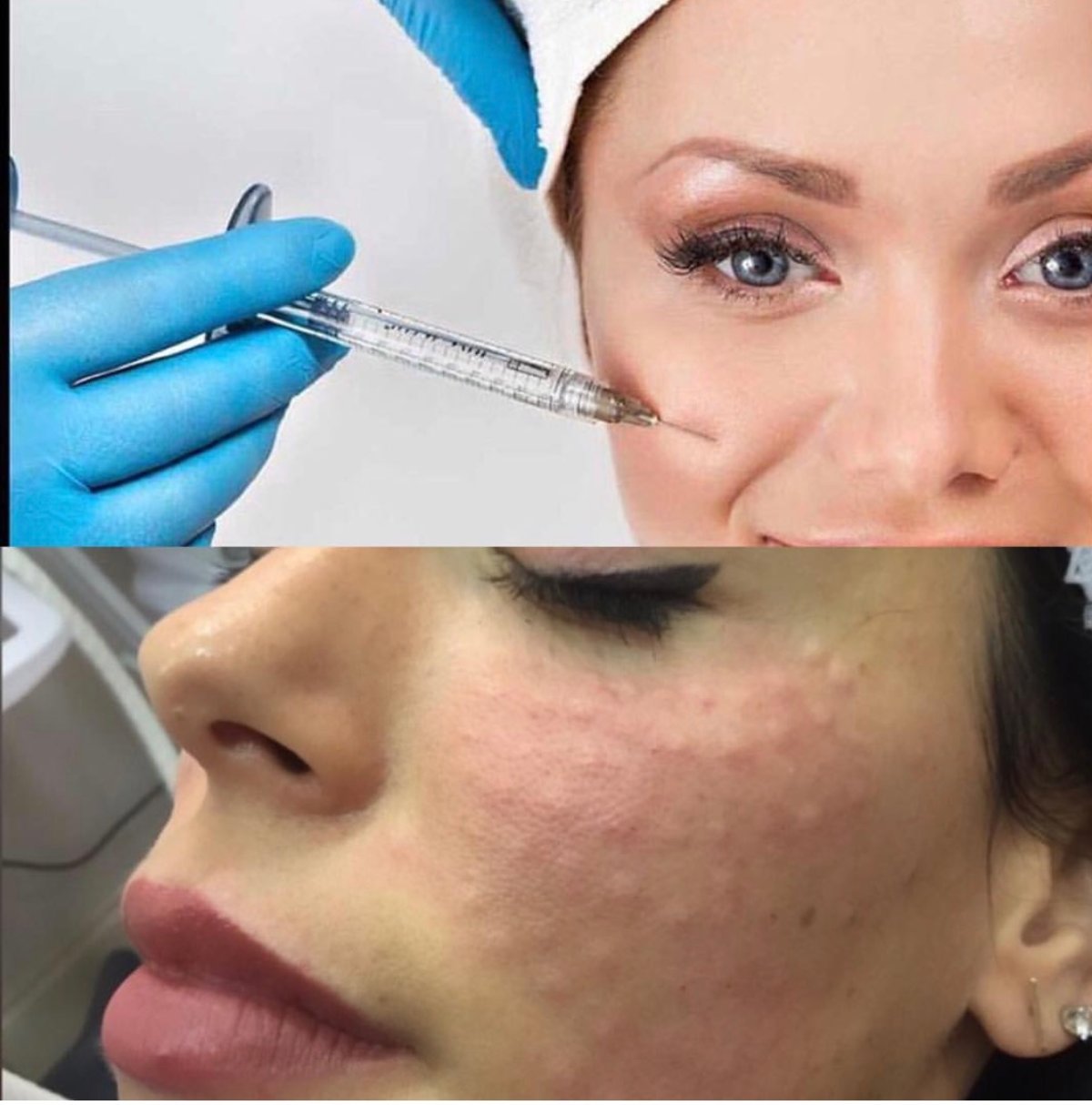 Baby Botox: A Comprehensive Guide to Subtle Aesthetic Enhancements