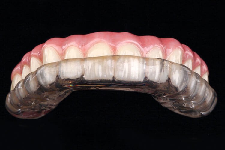 Complete night guards for teeth grinding Guide for Success