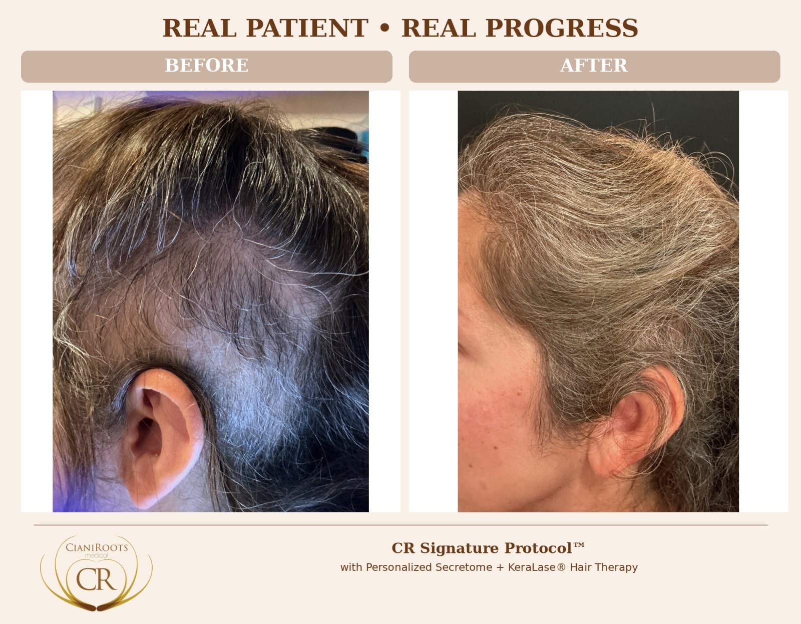 Male Pattern Baldness: Signs, Causes, and Personalized Next Steps