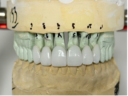 how to clean porcelain veneers: Everything You Need to Know