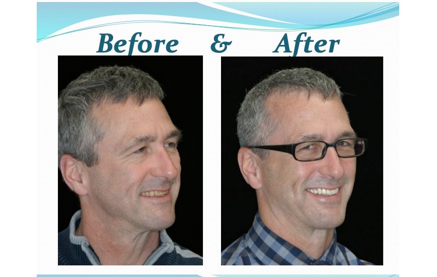 what does full mouth reconstruction involve Best Practices and Expert Advice
