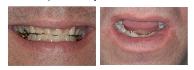 Complete bruxism treatment 11364 Guide for Success