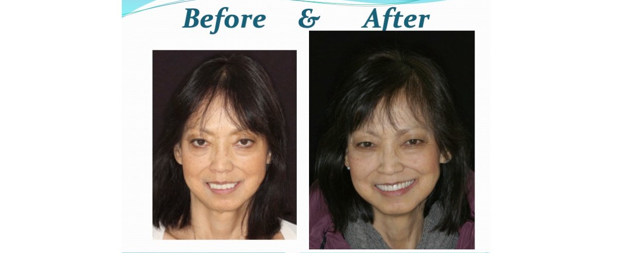 Best Dentures in Falls Church, VA: A Specialist’s Guide to Elite Restorations (2026)