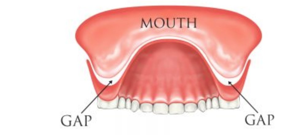 How to Master how to fix loose dentures for Better Results