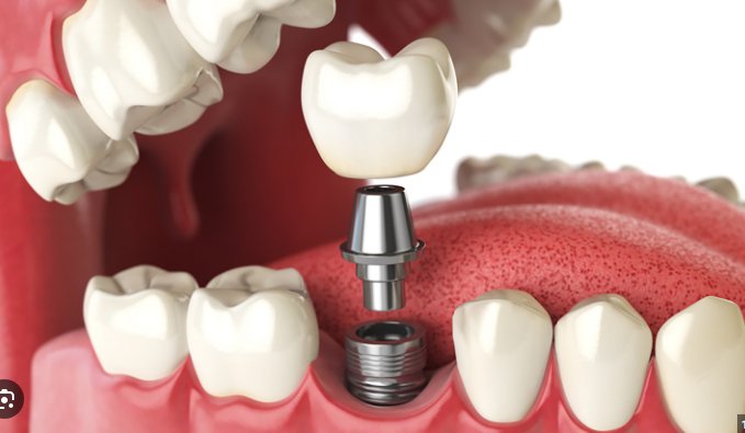 The Ultimate Guide to are dental implants worth it