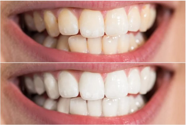 Teeth Whitening in Falls Church, VA: A Specialist’s Guide to Elite Results (2026)
