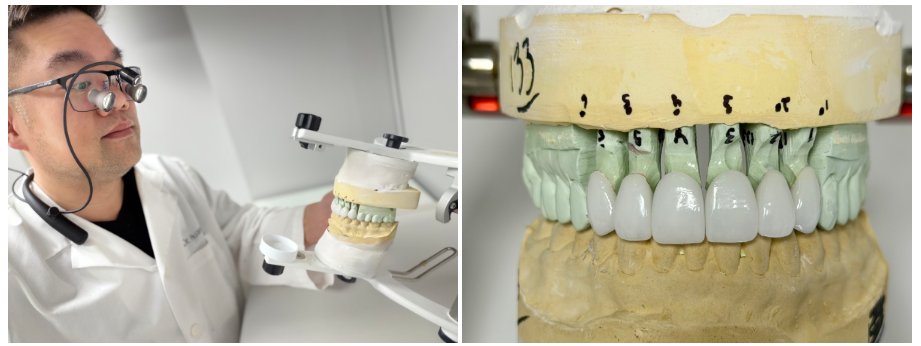 The Ultimate Guide to how long do veneers last