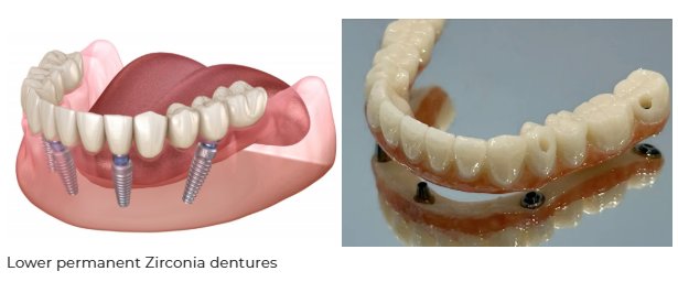 all on 4 dental implants virginia Best Practices and Expert Advice