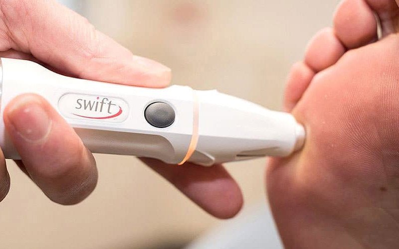 Expert Podiatrist for Warts on Foot near Woodstock: Relief with Swift™ Treatment